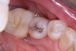 Figure 3: Defective amalgam Figure 3: Defective amalgam