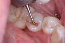 Figure 4: Cavity preparation Figure 4: Cavity preparation