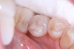 Figure 5: Omnichroma prior to curing Figure 5: Omnichroma prior to curing