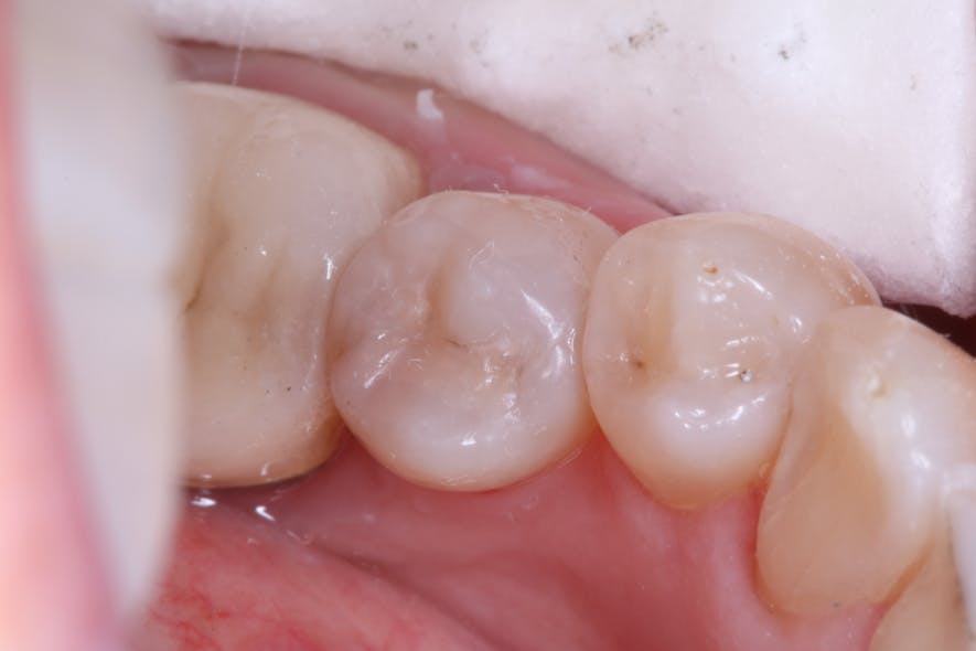 Figure 6: After curing, occlusal adjustment and polishing