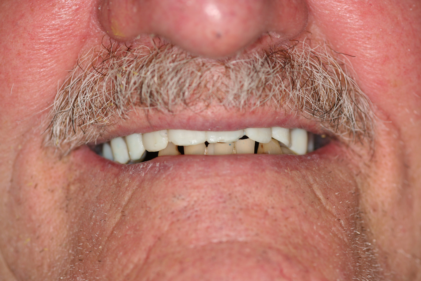 Dentures In A Day Reviews - Then, One Month Later I Came Back For Miner Adjustment.