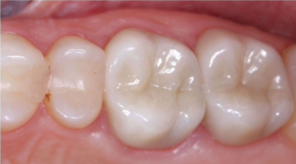 Which Crown Goes Where Dental Economics