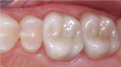 Figure 1: These two molar teeth could be restored for a few years using resin-based composite, but subsequent breakdown of the tooth and composite would eventually require crowns or onlays. The zirconia crowns (BruxZir and other brands, original zirconia, 3Y zirconia, Class 5, full-strength zirconia), now well proven in 10 years of research, will serve the patient many years.