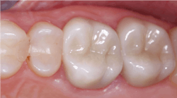 Figure 1: These two molar teeth could be restored for a few years using resin-based composite, but subsequent breakdown of the tooth and composite would eventually require crowns or onlays. The zirconia crowns (BruxZir and other brands, original zirconia, 3Y zirconia, Class 5, full-strength zirconia), now well proven in 10 years of research, will serve the patient many years. Figure 1: These two molar teeth could be restored for a few years using resin-based composite, but subsequent breakdown of the tooth and composite would eventually require crowns or onlays. The zirconia crowns (BruxZir and other brands, original zirconia, 3Y zirconia, Class 5, full-strength zirconia), now well proven in 10 years of research, will serve the patient many years.