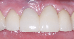 Figure 2: Some artistic dental laboratory technicians are staining the 3Y zirconia in the presintered state, firing the restorations, and producing the esthetic beauty of these four anterior restorations. However, expect lab fees to be higher than for mono-color superficially stained zirconia crowns.