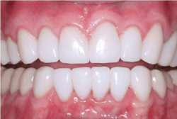 Figure 3: IPS e.max has proven success for single crowns over 10 years of research. It is difficult to improve on the beautiful esthetic result of these crowns. Some low-stress anterior tooth areas can even have three-unit e.max FPDs.