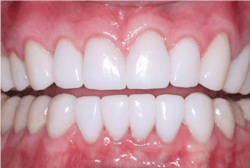 Figure 3: IPS e.max has proven success for single crowns over 10 years of research. It is difficult to improve on the beautiful esthetic result of these crowns. Some low-stress anterior tooth areas can even have three-unit e.max FPDs. Figure 3: IPS e.max has proven success for single crowns over 10 years of research. It is difficult to improve on the beautiful esthetic result of these crowns. Some low-stress anterior tooth areas can even have three-unit e.max FPDs.