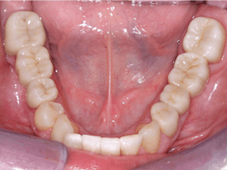 Figure 4: These 3Y zirconia crowns and FPDs have already served for seven years with no signs of any challenges. Three-unit 3Y zirconia bridges are well proven over at least 10 years.