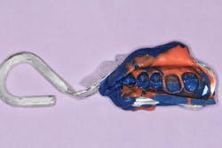 Figure 1: A typical single-unit crown impression of an upper first molar Figure 1: A typical single-unit crown impression of an upper first molar