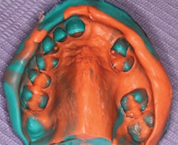 Figure 3: Impression taken with a custom tray fabricated from a previously prepared study model Figure 3: Impression taken with a custom tray fabricated from a previously prepared study model