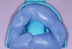 Figure 4: Putty (V-Posil) has already been hand mixed, rolled into a sausage shape, and placed into the appropriately sized maxillary tray Figure 4: Putty (V-Posil) has already been hand mixed, rolled into a sausage shape, and placed into the appropriately sized maxillary tray
