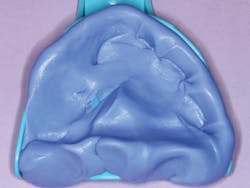 Figure 5: Placement of finger indentations for tooth spaces, coupled with pinching and elevation of the putty at the palatal seal area Figure 5: Placement of finger indentations for tooth spaces, coupled with pinching and elevation of the putty at the palatal seal area