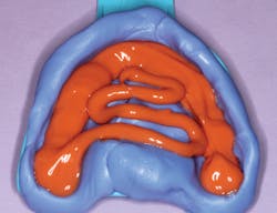 Figure 6: Spaced putty is removed from the mouth while still unset with an appropriate amount of wash loaded in the putty