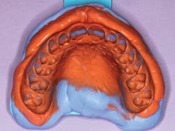 Figure 7: Optimal final impression with detailed borders and all hard and soft tissues captured Figure 7: Optimal final impression with detailed borders and all hard and soft tissues captured