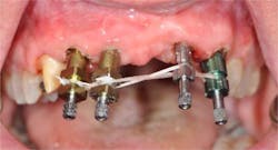 Figure 1: Open-tray impression copings are connected with floss, which is used as a base for the acrylic material. Figure 1: Open-tray impression copings are connected with floss, which is used as a base for the acrylic material.