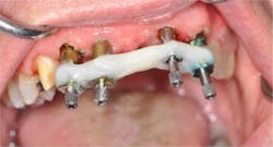 Figure 2: Acrylic is placed over the floss to rigidly splint the copings together. At this point it would be wise to ensure that you have a proper path of insertion for the entire unit. This will guarantee it doesn&rsquo;t get locked on with your tray.