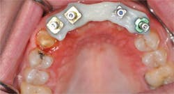 Figure 3: Once the material has set completely, a fine disk between the copings sections the jig in between each implant to alleviate the stress caused by material shrinkage. Figure 3: Once the material has set completely, a fine disk between the copings sections the jig in between each implant to alleviate the stress caused by material shrinkage.