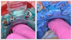 Figure 4: Seat the tray with your impression material (Honigum Pro, DMG), allowing the open-tray abutments to exit in the holes placed in the tray. Cotton or Teflon tape can be placed in the screw holes to ease the removal of the loose impression material. After unscrewing, the jig and impression will all be removed in one piece. Figure 4: Seat the tray with your impression material (Honigum Pro, DMG), allowing the open-tray abutments to exit in the holes placed in the tray. Cotton or Teflon tape can be placed in the screw holes to ease the removal of the loose impression material. After unscrewing, the jig and impression will all be removed in one piece.