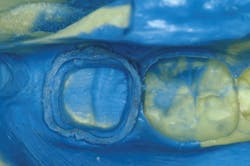 Figure 2: Impressions, whether scanned or (as in this case) made with VPS, must show all of the margins and have no voids, tears, separations, or other defects. Unfortunately, that is not the case in the majority of impressions, as reported by large laboratories. Figure 2: Impressions, whether scanned or (as in this case) made with VPS, must show all of the margins and have no voids, tears, separations, or other defects. Unfortunately, that is not the case in the majority of impressions, as reported by large laboratories.