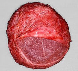 Figure 1: Fibrous envelope surrounding breast implant involved with capsular contracture.
