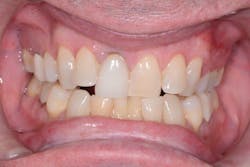 Figure 2: Before: The existing crown Figure 2: Before: The existing crown