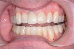 Figure 4: After: Crown milled in-house using CS 3700, CS ScanFlow, and smart shade matching Figure 4: After: Crown milled in-house using CS 3700, CS ScanFlow, and smart shade matching