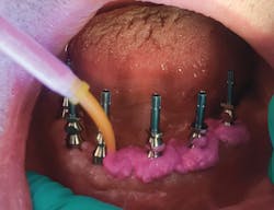 Figure 5: Syringing of light-body wash PVS material around the multiunit abutment upon healing Figure 5: Syringing of light-body wash PVS material around the multiunit abutment upon healing