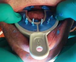 Figure 6: Seating of the MiraTray implant impression tray in the mouth Figure 6: Seating of the MiraTray implant impression tray in the mouth