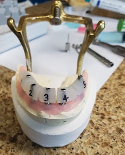 Figure 7: Multiunit verification jigs (ProSmiles Dental Studio) Figure 7: Multiunit verification jigs (ProSmiles Dental Studio)