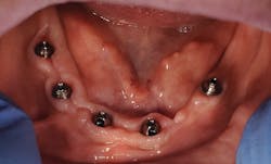 Figure 8: Proper multiunit height and healing Figure 8: Proper multiunit height and healing
