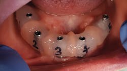 Figure 9: Luting the verification jigs in place in the mouth