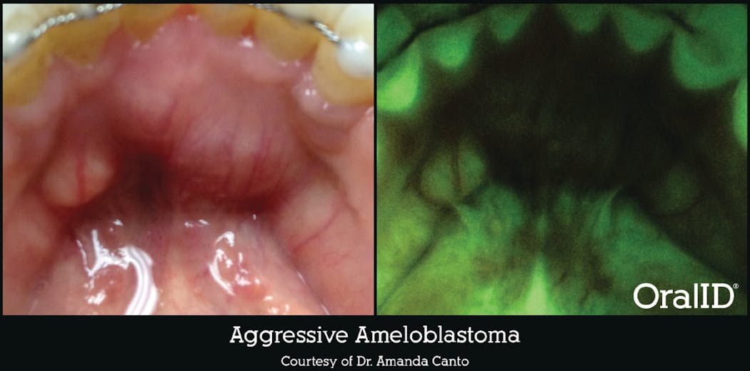 Figure 3: Aggressive ameloblastoma revealed through OralID fluorescence technology. Courtesy of Forward Science. Used with permission.
