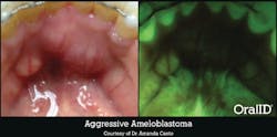 Figure 3: Aggressive ameloblastoma revealed through OralID fluorescence technology. Courtesy of Forward Science. Used with permission.