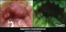 Figure 3: Aggressive ameloblastoma revealed through OralID fluorescence technology. Courtesy of Forward Science. Used with permission. Figure 3: Aggressive ameloblastoma revealed through OralID fluorescence technology. Courtesy of Forward Science. Used with permission.