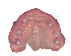 Figure 2: Digital full-arch scan on Trios using scan bodies (Dess Nobel RP) Figure 2: Digital full-arch scan on Trios using scan bodies (Dess Nobel RP)