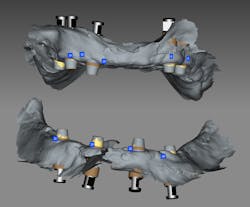 Figure 5: The soft-tissue and scan-body scans were combined and exported into Exocad. Figure 5: The soft-tissue and scan-body scans were combined and exported into Exocad.