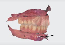 Figure 6: A preoperative scan of the patient's converted denture was taken with a Trios scanner. Figure 6: A preoperative scan of the patient's converted denture was taken with a Trios scanner.