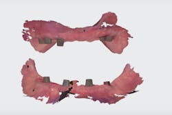 Figure 7: A soft-tissue scan with healing abutments was taken with a Trios scanner. Figure 7: A soft-tissue scan with healing abutments was taken with a Trios scanner.