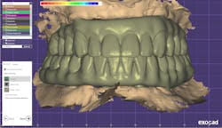 Figure 8: In Exocad, a set of hybrids was designed and completed by Burbank Dental Lab. Figure 8: In Exocad, a set of hybrids was designed and completed by Burbank Dental Lab.
