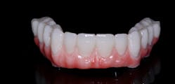 Figure 9: Gingival composite was layered, and acrylic stains and glazes were used on this monolithic PMMA set of hybrids.