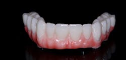 Figure 9: Gingival composite was layered, and acrylic stains and glazes were used on this monolithic PMMA set of hybrids. Figure 9: Gingival composite was layered, and acrylic stains and glazes were used on this monolithic PMMA set of hybrids.