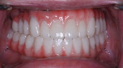 Figure 10: A passive fit and no occlusal adjustment needed on this dual-arch hybrid case