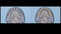 Figure 2: Dies of tooth preparations designed to eliminate orthodontic malpositioning and IPS e.max lithium disilicate single crowns (class 3 ceramic restorations) Figure 2: Dies of tooth preparations designed to eliminate orthodontic malpositioning and IPS e.max lithium disilicate single crowns (class 3 ceramic restorations)