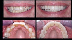 Figure 3: Before-and-after lithium disilicate crowns that were polished only, without glaze and stain on the surface, which provides more permanent color acceptability than staining and glazing. The informed consent included extensive education on the six characteristics of informed consent as well as selection of the preferred treatment. The risk implications of the patient&rsquo;s denial of orthodontics were thoroughly explained.