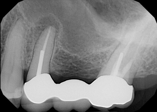 Figure 1: Pre-op x-ray