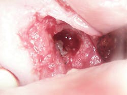Figure 3: Immediately post-op Figure 3: Immediately post-op