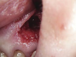 Figure 4: Immediately post-op Figure 4: Immediately post-op
