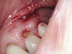 Figure 5: Immediately post-op Figure 5: Immediately post-op