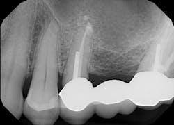 Figure 6: X-ray immediately after placement of bone-graft material Figure 6: X-ray immediately after placement of bone-graft material