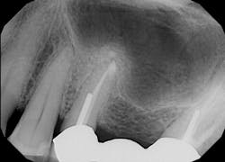 Figure 7: X-ray immediately after placement of bone-graft material